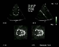 Ultrasound Upgrade Produces Images That Work Like 3-D Movies