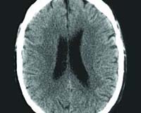 Yale Team Finds Neural Thermostat Keeps Brain Running Efficiently
