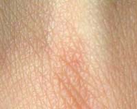 Unexpected Bacterial Diversity On Human Skin