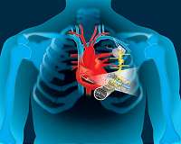 Engineers harvest heart's energy to power life-saving devices