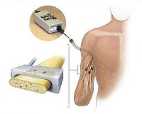 Why bioelectrodes for energy conversion are not stable