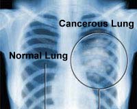 One step closer to a breath test for lung cancer