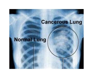 Coal From Mass Extinction Era Linked To Lung Cancer Mystery