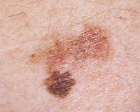 Software as good as doctors at diagnosing skin cancer
