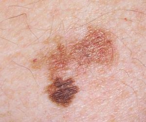 Aspirin may lower melanoma risk