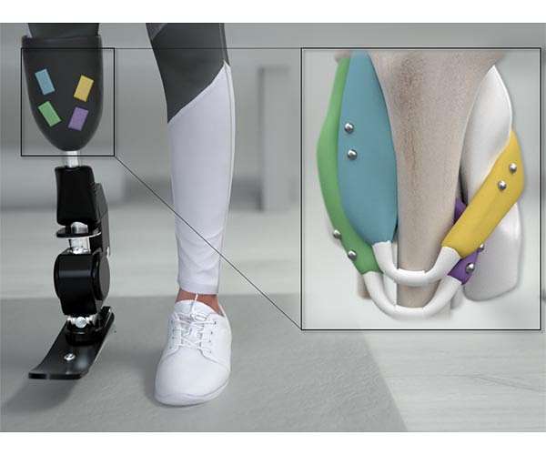 Magnets could offer better control of prosthetic limbs