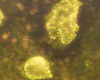 Nano-particles Could Strangle Cancer Cells