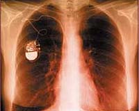 Pacemakers at danger from hackers: study