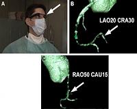First-in-man use of virtual reality imaging in cardiac cath lab to treat blocked coronary artery